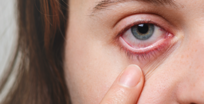 Come ridurre al minimo i sintomi delle allergie oculari.