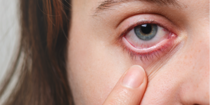 Come ridurre al minimo i sintomi delle allergie oculari.